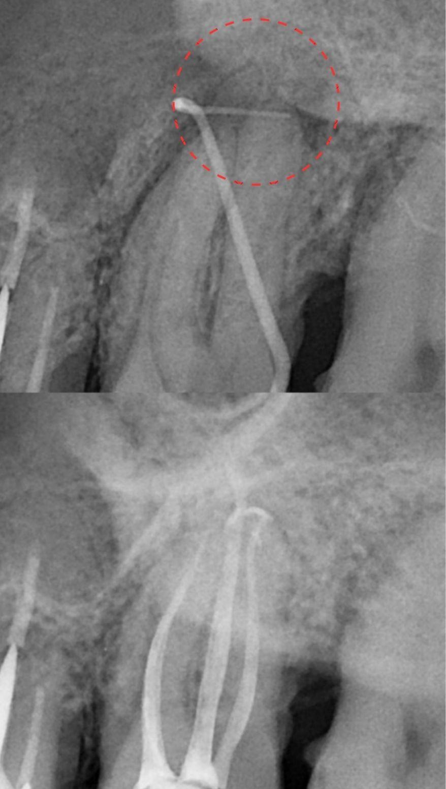 Endodoncija