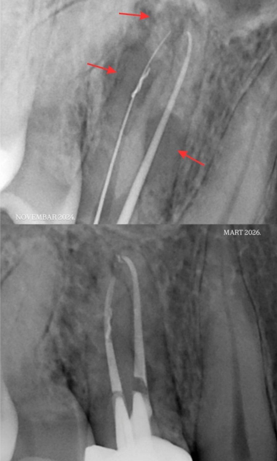 Endodoncija
