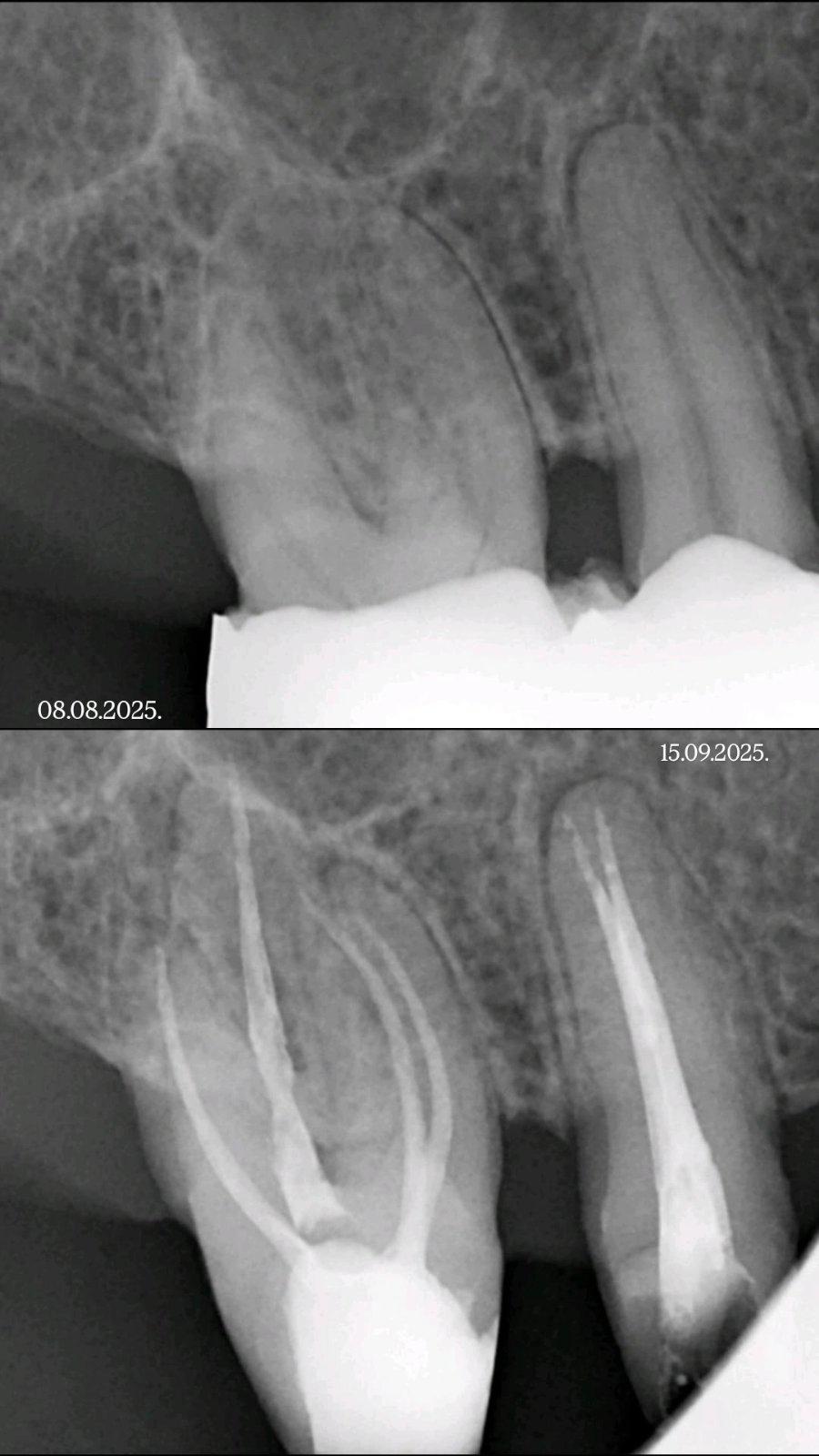 Endodoncija